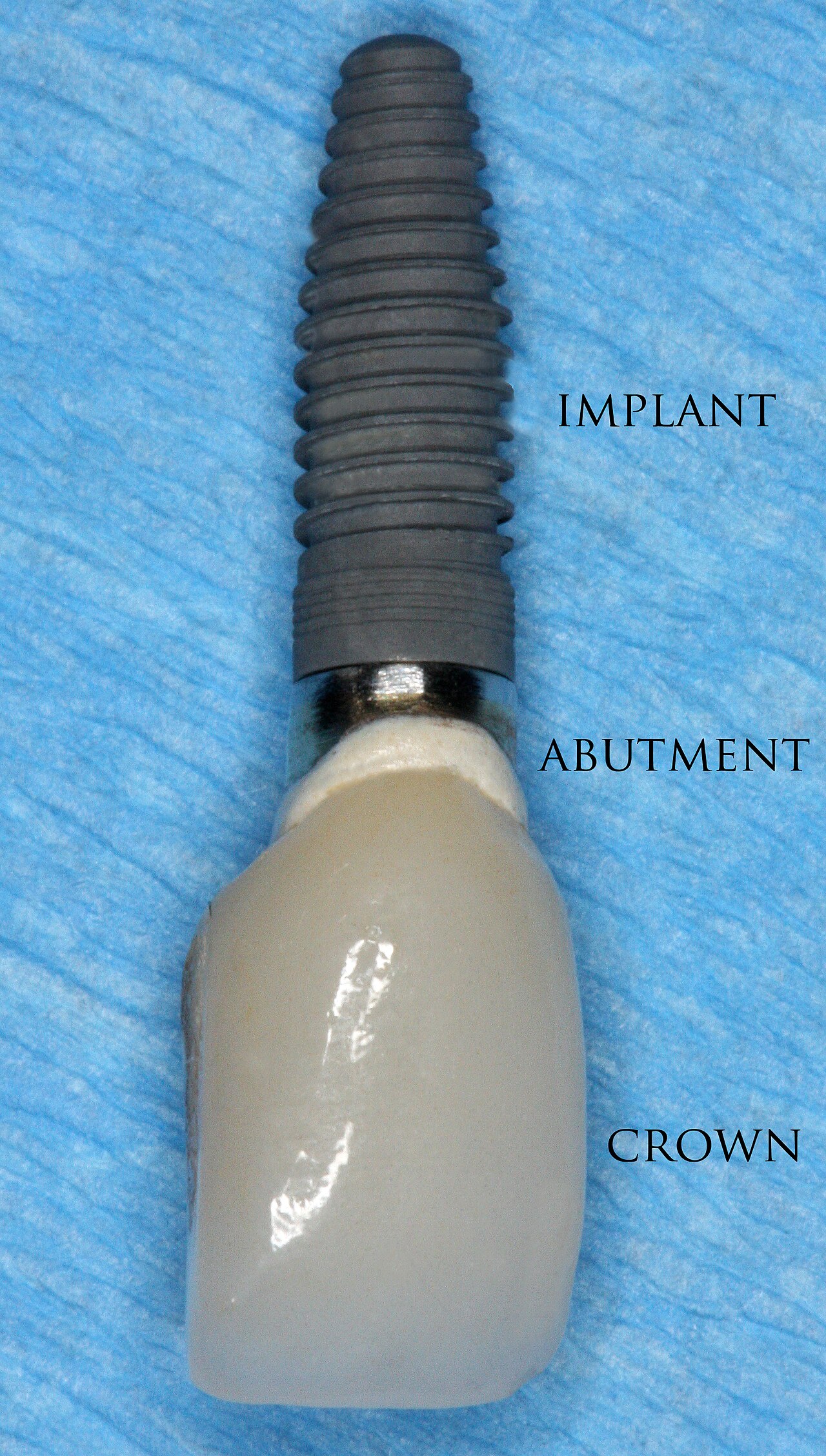 Couronne dentaire sur implant en titane