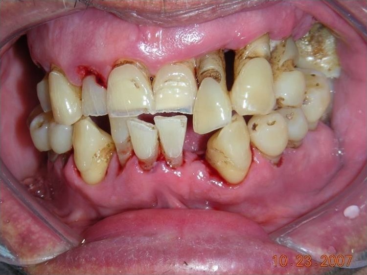 Gencive Gonflee et Infection : Causes, Traitement et Urgence